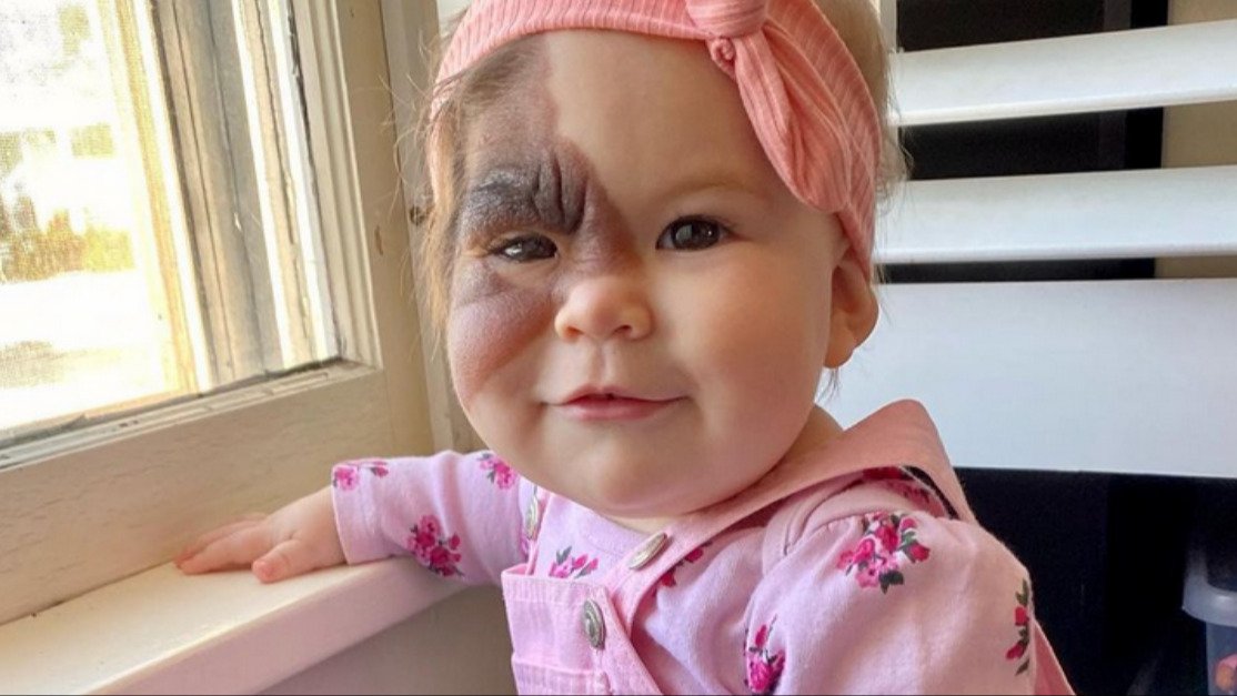 Mom Pledges To Show Baby Daughter Born With Rare Birthmark That She's  Beautiful – Diply