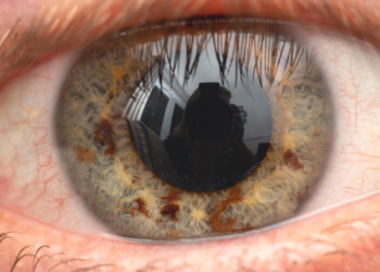 Colored iris