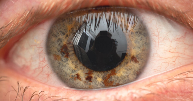 Colored iris