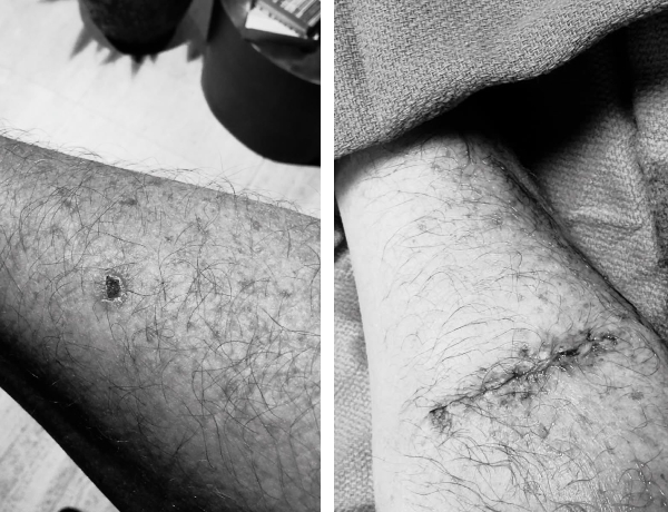 Julian's skin before and after surgery