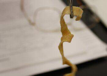 X-ray reveals cysts of tapeworm larvae in a patient