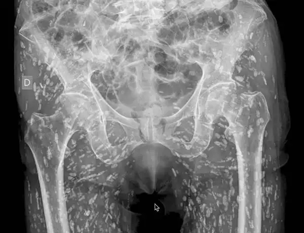 Tapeworm cysts in x-ray