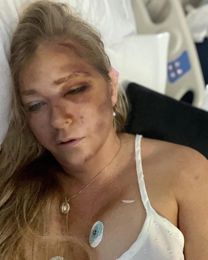 virginia giuffre with severe bruises