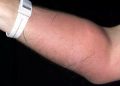 Swollen arm