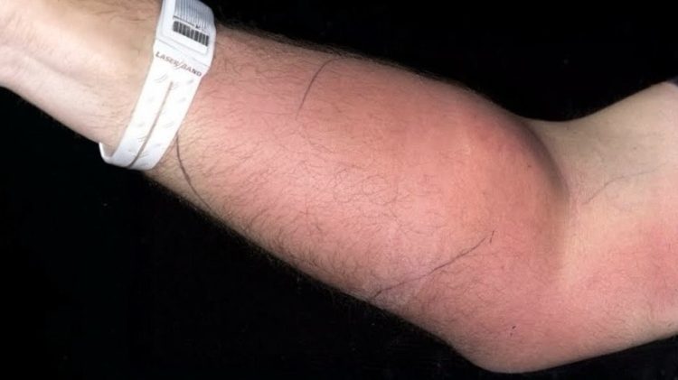 Swollen arm